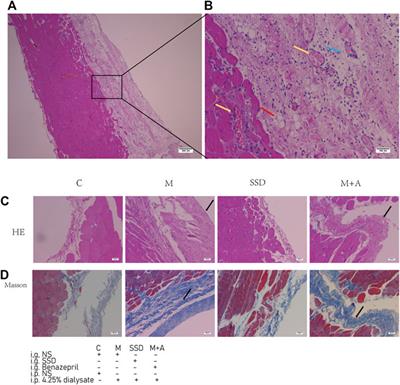 Saikosaponin D Inhibits Peritoneal Fibrosis in Rats With Renal Failure by Regulation of TGFβ1/ BMP7 / Gremlin1/ Smad Pathway